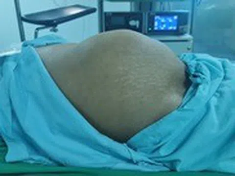 Cứu chữa bệnh nhân người Lào mang 4,5 lít mủ, bụng to như mang thai 8 tháng