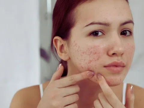 Lý do bạn dễ bị mụn trứng cá hơn người khác