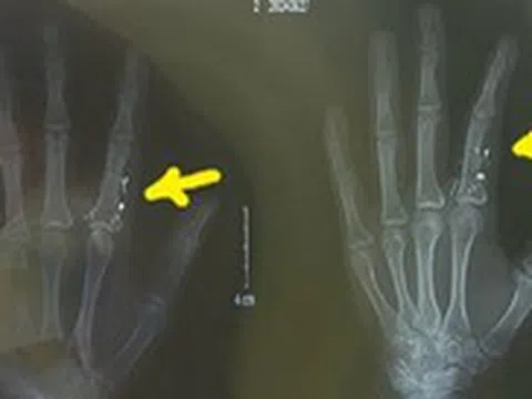 Nhiệt kế vỡ: Nguy hiểm nhiễm độc thủy ngân, nguy cơ lớn nếu dùng máy hút bụi dọn
