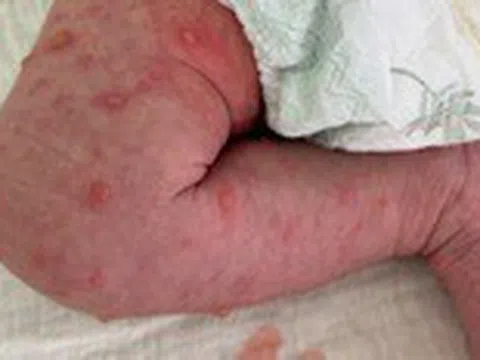 Trẻ sơ sinh mắc thủy đậu lây từ mẹ, cần chú ý ‘thời gian vàng’ điều trị
