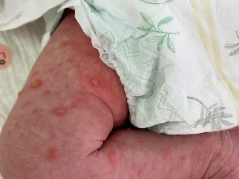 Bé sơ sinh nổi mụn nước toàn thân vì lây từ mẹ