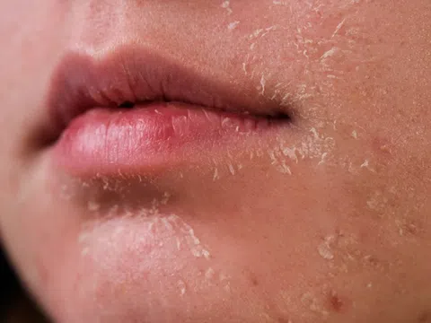 Những kiểu peel da phổ biến