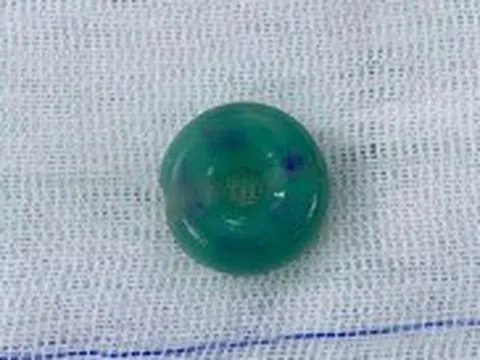 Nhiều bé gái bị dị vật lọt vào 'vùng kín', nguy cơ ảnh hưởng chức năng sinh sản