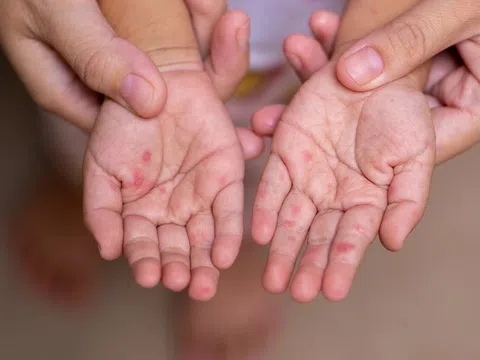 Lý do quan trọng khiến trẻ mắc bệnh sởi