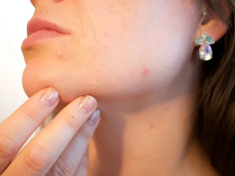 Vì sao mụn trứng cá dễ tái phát và viêm nhiễm?