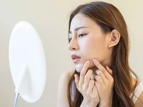 Mụn ẩn có nên nặn không?