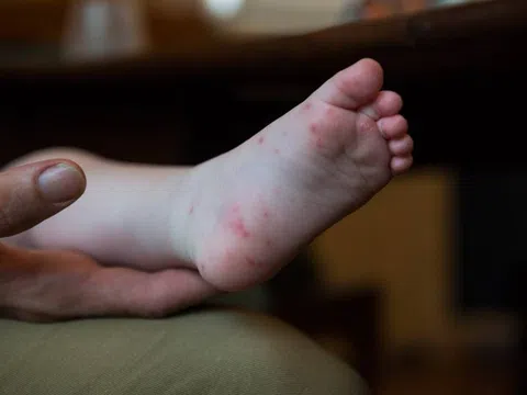 Dấu hiệu phát hiện sớm bệnh tay chân miệng 