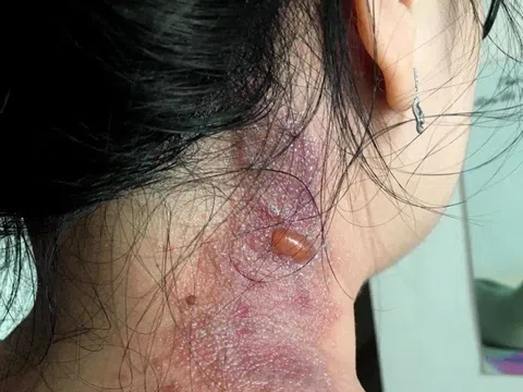 Các nhận biết và xử trí vết thương do kiến ba khoang