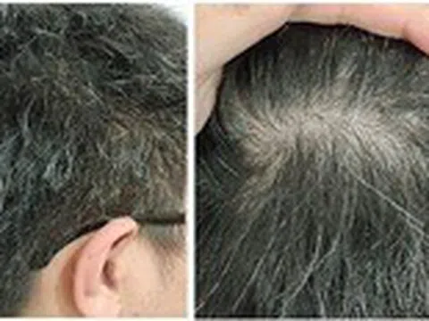 Tóc bạc sớm ở người trẻ, vì đâu nên nỗi?