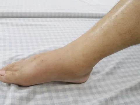 Thận hư mức độ nặng ở tuổi 30 vì điều trị sai lầm