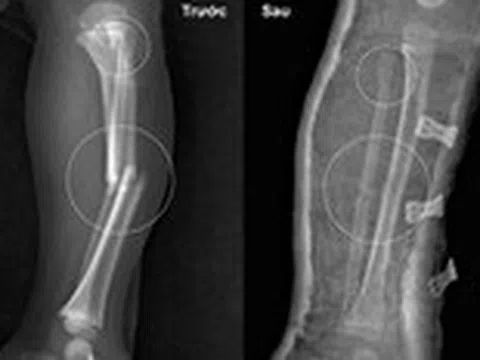 Bác sĩ hướng dẫn sơ cứu gãy xương đúng cách trước khi đến bệnh viện