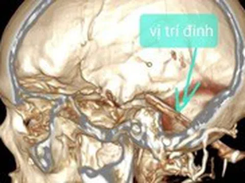 Hy hữu: Người đàn ông bị đinh 7cm đâm vào não gần 1 năm mới phát hiện