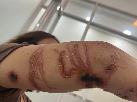 Tay chân lở loét sau khi tắm biển