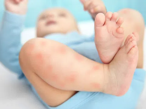 Cảnh giác với bệnh trẻ thường mắc trong mùa hè