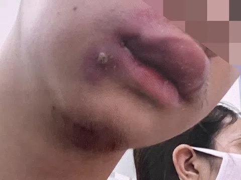 Chàng trai bị nhiễm khuẩn huyết chỉ vì tự nặn mụn