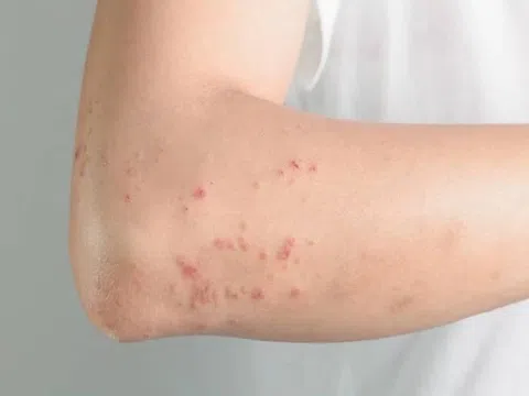 Dấu hiệu bạn đã nhiễm ký sinh trùng
