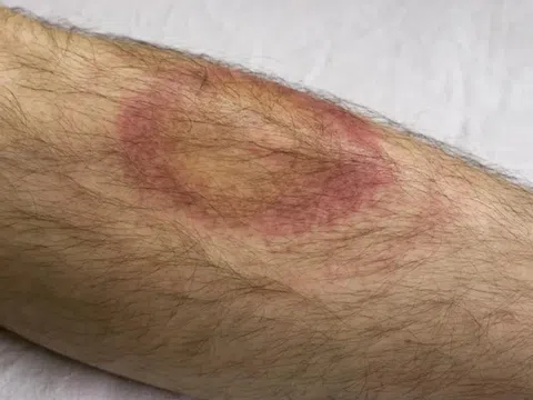 4 bệnh về da hay gặp mùa mưa lũ