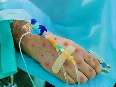 WHO cân nhắc ban bố tình trạng khẩn cấp về đậu mùa khỉ