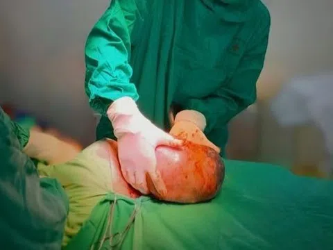 Hình ảnh em bé chào đời nằm gọn trong bọc điều