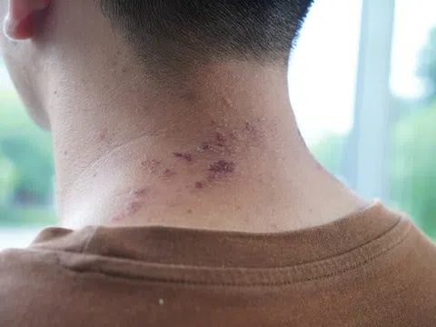 Nhiều trẻ vào viện vì kiến ba khoang