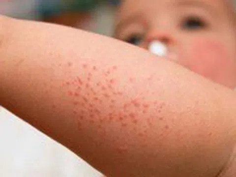 TP.HCM: 60 ca sốt phát ban trong tuần, nghi bệnh sởi