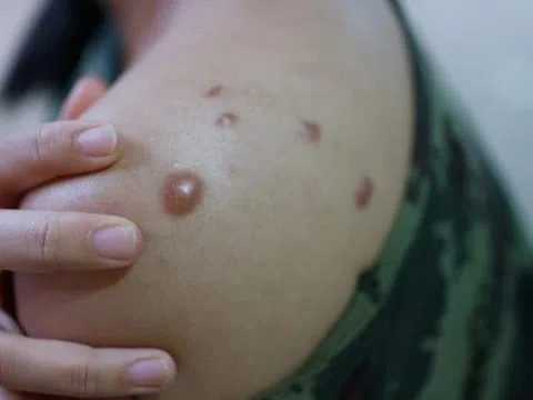 Đậu mùa khỉ đáng ngại thế nào WHO lại mở họp khẩn?