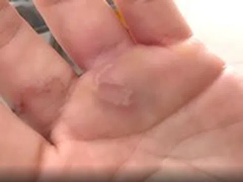 Có vệt dài loằng ngoằng nổi sần ở bàn tay, nữ bệnh nhân nhiễm giun đũa chó mèo