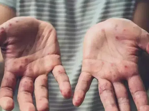 Đường lây truyền chính của bệnh đậu mùa khỉ