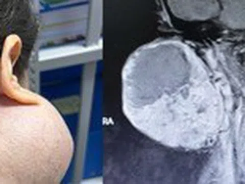 Trì hoãn 14 năm không điều trị, người phụ nữ suýt mất mạng vì khối u khổng lồ trên mặt