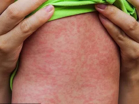 Ca mắc sởi tại TPHCM tăng nhanh, Bộ Y tế đề nghị tăng cường kiểm soát