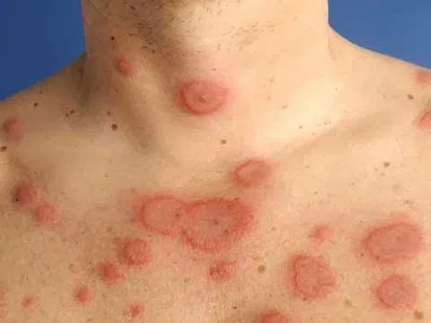 Biểu hiện của lupus ban đỏ