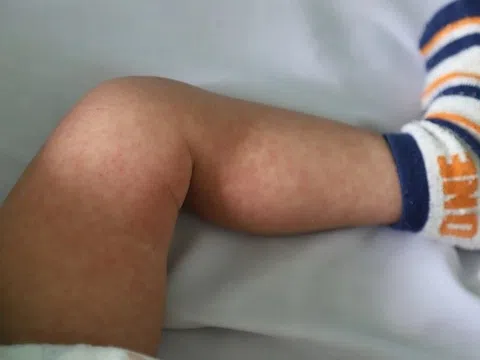 Nhiều phụ huynh 'né' tiêm vaccine sởi vì sợ con suy yếu
