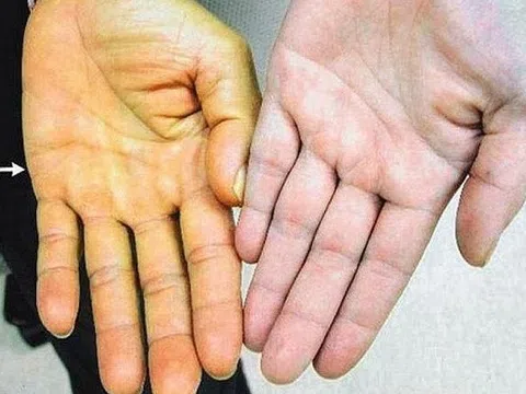 Nhập viện trong đau đớn vì sai lầm khi chữa táo bón