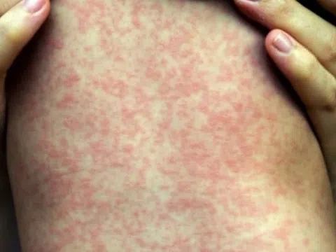 Bộ Y tế nói gì về việc TP.HCM công bố dịch sởi trên địa bàn?