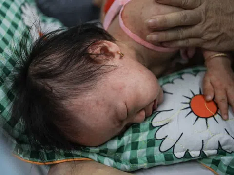 TP.HCM công bố dịch sởi