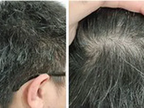 Day bấm huyệt trị được tóc bạc, tóc rụng?
