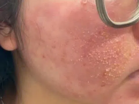 Chi 20 triệu để ‘trị sạch mụn sau 7 ngày’, thiếu nữ sưng phù khắp mặt