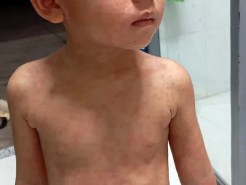 Đồng Nai chuẩn bị triển khai chiến dịch tiêm vaccine sởi