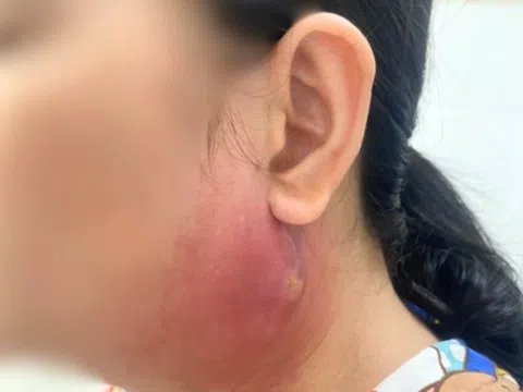 Người phụ nữ phải vào phòng phẫu thuật chỉ vì nốt mụn nhọt