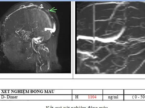 Đau đầu 4 ngày, đến viện mới phát hiện mắc thể đột quỵ não đặc biệt