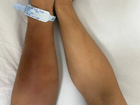 Suýt phải cắt bỏ tay vì nhiễm vi khuẩn 'ăn thịt người'