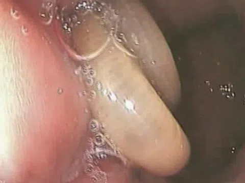 Giun dài đến 10 cm lúc nhúc trong cơ thể người đàn ông