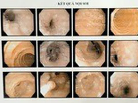 Hy hữu ca bệnh có u chi chít trong dạ dày và mọc khắp cơ thể