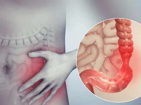 Dấu hiệu nhận biết bệnh viêm ruột