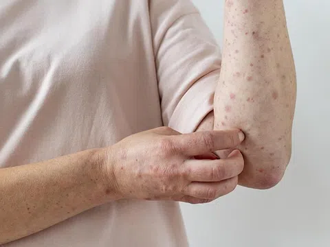 Đậu mùa khỉ đi đến đâu sau 1 tháng là mối nguy khẩn cấp toàn cầu