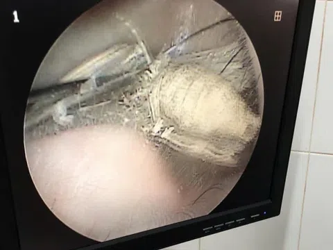 Ù tai, nghe kém do con bọ dài 3cm sống trong tai
