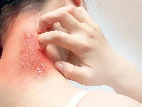 Bệnh về da sau mưa lũ gia tăng
