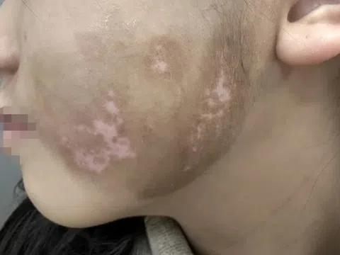 Nguyên nhân, triệu chứng, cách điều trị bệnh bạch biến