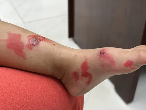 Đi học trở lại, bệnh chốc lây lan nhanh ở trẻ