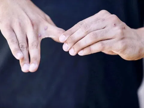 Nguyên tắc quan trọng để phòng bệnh đậu mùa khỉ